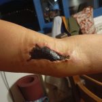 Una vecina de San José tuvo que ingresar en “Críticos” por la picadura de una araña Esta fue la lesion cutanea que dejo la arana a la vecina de San Jose. Afortunadamente ha evolucionado muy bien